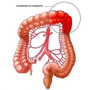 Ischemia of the intestine